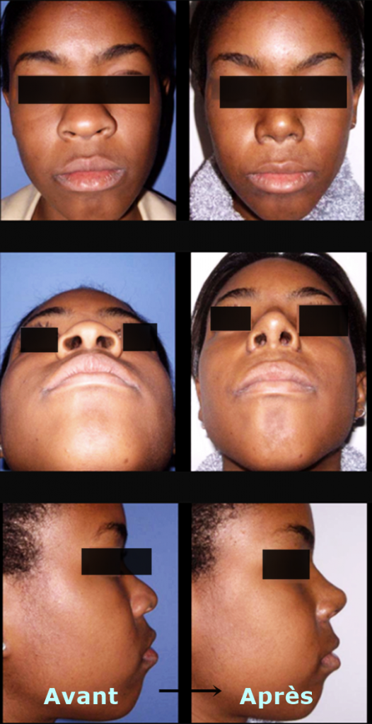 rhinoplastie ethnique avant apres