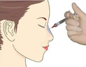 rhinoplastie médicale injection acide hyaluronique