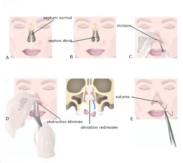 Какие операции делают на носу. Турунды септопластика. Септопластика носовой перегородки операция. Подслизистая резекция перегородки носа. Пластины для операции септопластика.